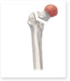 Removal of Femoral Head