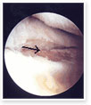 Ostearthritic cartilage